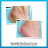 Before and after comparison of cracked heels treated with foot care cream.
