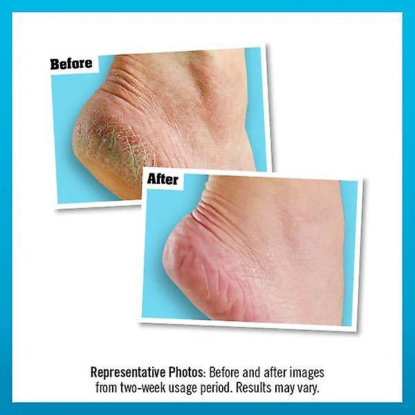 Before and after comparison of cracked heels treated with foot care cream.