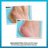 Before and after comparison of cracked heels treated with foot care cream.