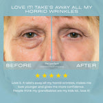 My Perfect eyes result before and after images